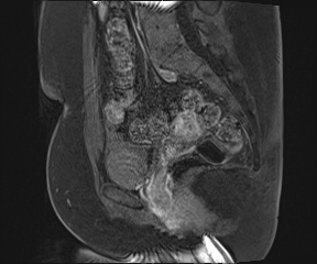 File:Class II Mullerian duct anomaly- unicornuate uterus with rudimentary horn and non-communicating cavity (Radiopaedia 39441-41755 G 63).jpg