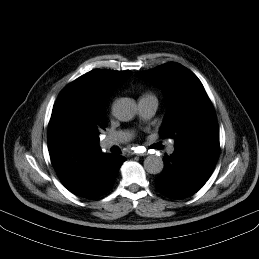 File:Classic complicated silicosis (Radiopaedia 49720-54961 Axial liver window 28).jpg