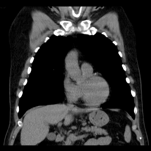 File:Classic complicated silicosis (Radiopaedia 49720-54961 Coronal liver window 19).jpg