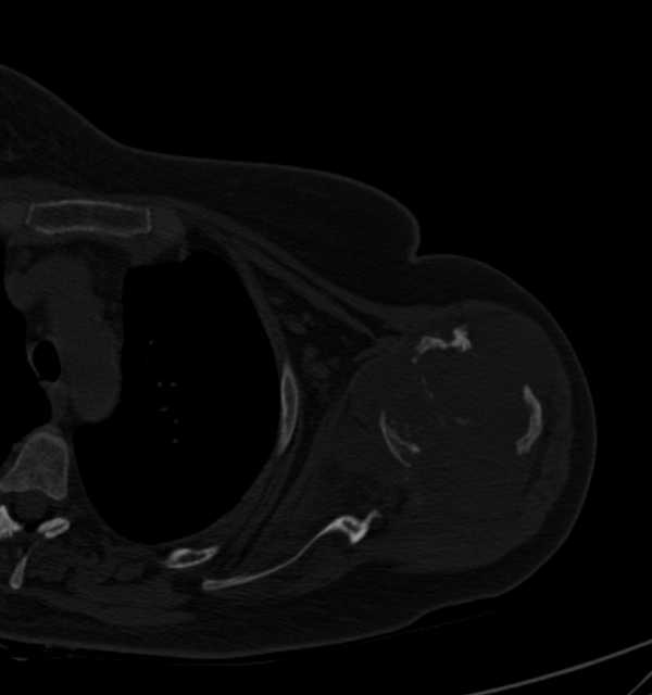 Clear cell chondrosarcoma - humerus (Radiopaedia 63104-71612 Axial bone window 49).jpg
