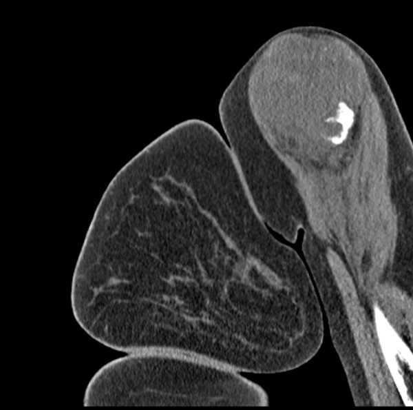 File:Clear cell chondrosarcoma - humerus (Radiopaedia 63104-71612 D 13).jpg