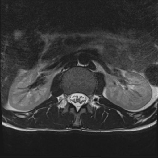 File:Clear cell meningoma - lumbar spine (Radiopaedia 60116-67690 Axial T2 39).png