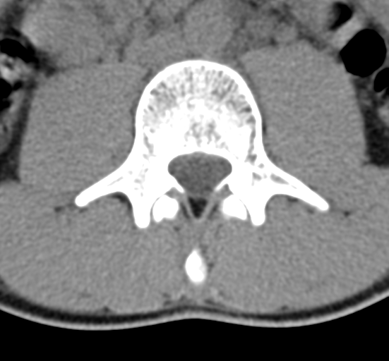 Clear cell meningoma - lumbar spine (Radiopaedia 60116-67691 Axial non-contrast 37).png