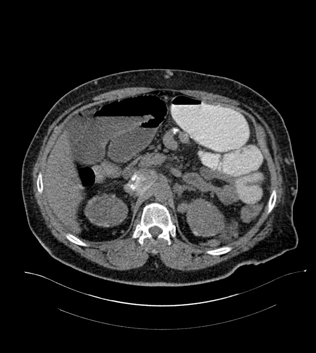 Closed-loop small bowel obstruction-internal hernia (Radiopaedia 78439-91096 Axial non-contrast 50).jpg