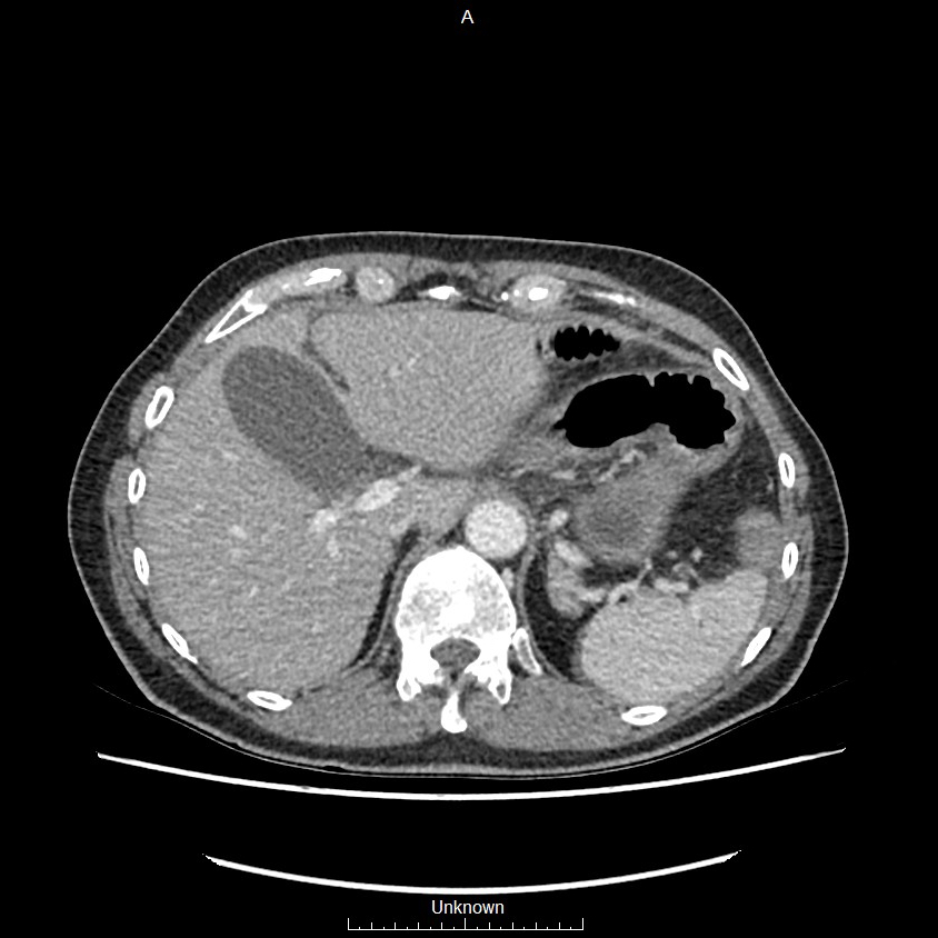 Closed loop bowel obstruction and ischemia (Radiopaedia 86959-103180 A 10).jpg