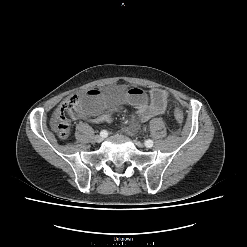 Closed loop bowel obstruction and ischemia (Radiopaedia 86959-103180 A 62).jpg