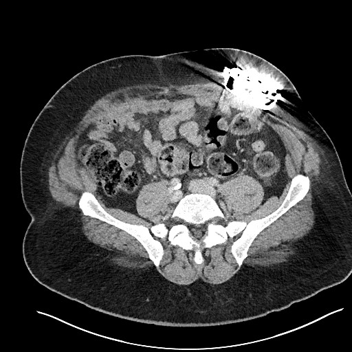 File:Closed loop obstruction - internal hernia into nephrectomy bed (Radiopaedia 59867-67320 A 98).jpg