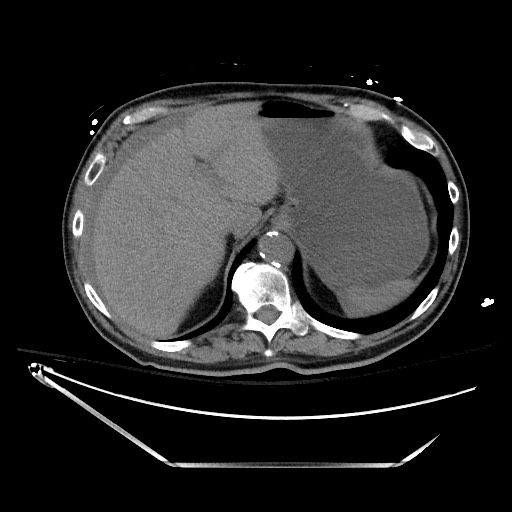 File:Closed loop obstruction due to adhesive band, resulting in small bowel ischemia and resection (Radiopaedia 83835-99023 Axial non-contrast 33).jpg