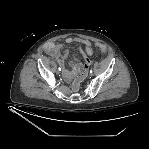 File:Closed loop obstruction due to adhesive band, resulting in small bowel ischemia and resection (Radiopaedia 83835-99023 B 125).jpg