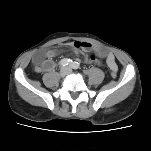 Closed loop small bowel obstruction (Radiopaedia 59227-66554 A 58).jpg