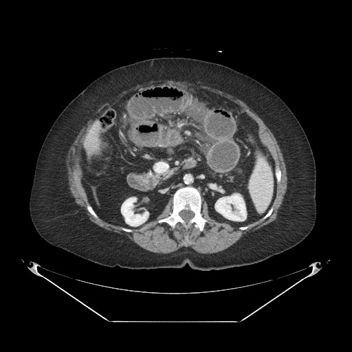 Closed loop small bowel obstruction - internal hernia (Radiopaedia 65402-74450 A 51).jpg