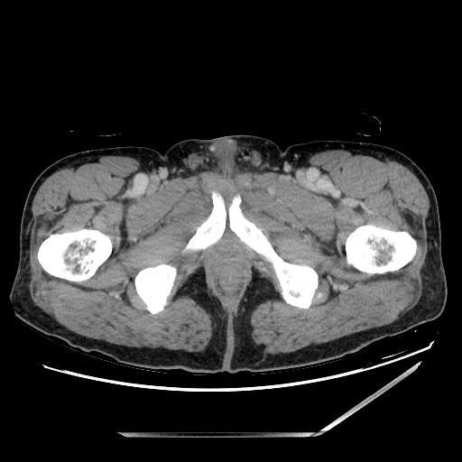 Closed loop small bowel obstruction - omental adhesion causing "internal hernia" (Radiopaedia 85129-100682 A 181).jpg