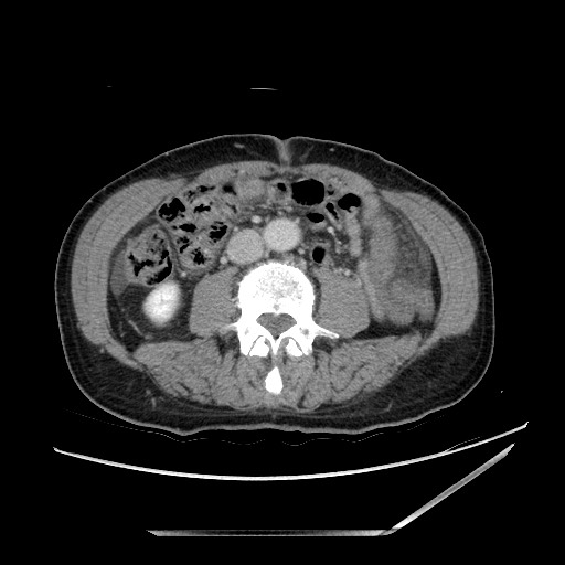 File:Closed loop small bowel obstruction - omental adhesion causing "internal hernia" (Radiopaedia 85129-100682 A 92).jpg