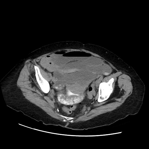 Closed loop small bowel obstruction due to adhesive band, with intramural hemorrhage and ischemia (Radiopaedia 83831-99017 Axial non-contrast 135).jpg