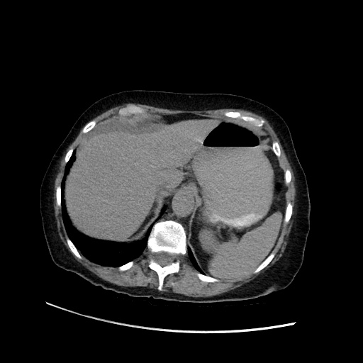 Closed loop small bowel obstruction due to adhesive band, with intramural hemorrhage and ischemia (Radiopaedia 83831-99017 Axial non-contrast 39).jpg