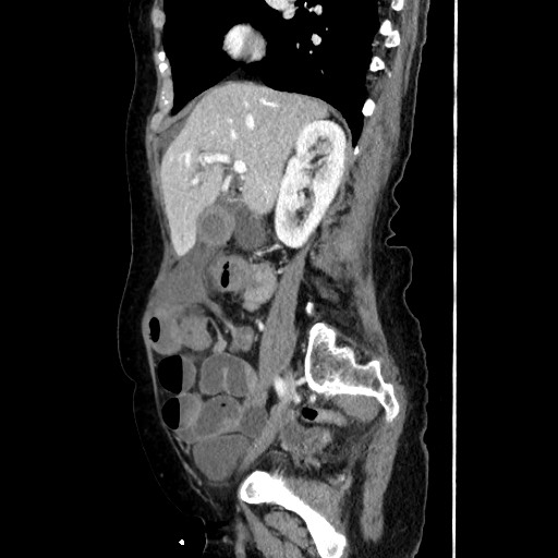 File:Closed loop small bowel obstruction due to adhesive band, with intramural hemorrhage and ischemia (Radiopaedia 83831-99017 D 81).jpg