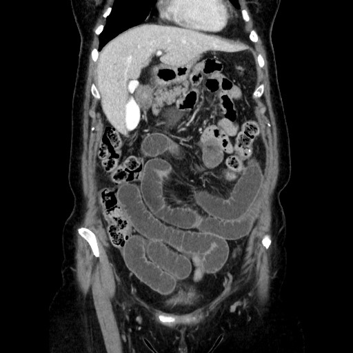 Closed loop small bowel obstruction due to adhesive bands - early and late images (Radiopaedia 83830-99015 B 41).jpg