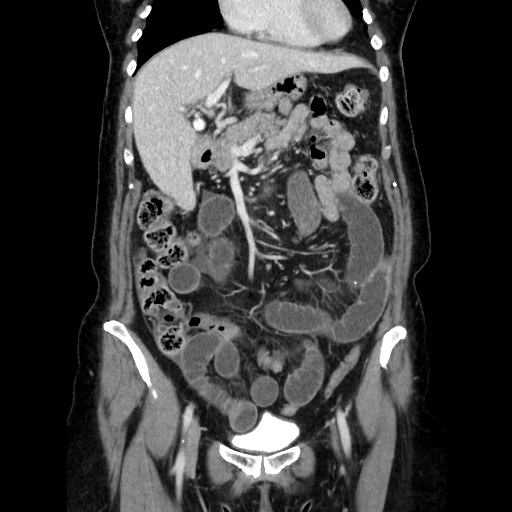 Closed loop small bowel obstruction due to adhesive bands - early and late images (Radiopaedia 83830-99015 B 47).jpg