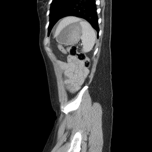 File:Closed loop small bowel obstruction due to trans-omental herniation (Radiopaedia 35593-37109 C 55).jpg