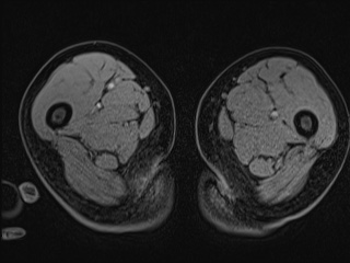 Closed loop small bowel obstruction in pregnancy (MRI) (Radiopaedia 87637-104031 G 55).jpg