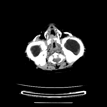 Cloverleaf skull (Radiopaedia 91901-109710 Axial non-contrast 42).jpg