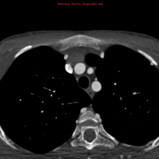 File:Coarctation of the aorta (Radiopaedia 12461-12697 A 11).jpg