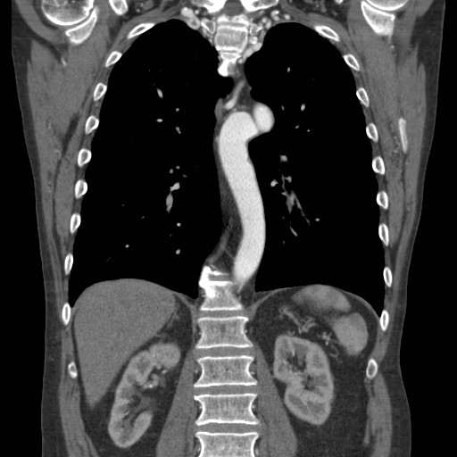 Coarctation of the aorta (Radiopaedia 17427-17116 A 34).jpg