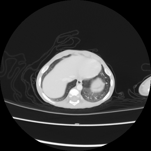Coarctation of the aorta and patent ductus arteriosus (Radiopaedia 68033-77499 Axial lung window 53).jpg