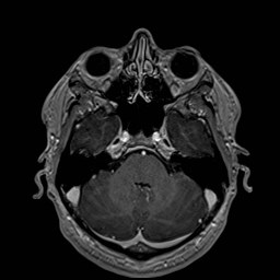 File:Cochlear incomplete partition type III associated with hypothalamic hamartoma (Radiopaedia 88756-105498 Axial T1 C+ 63).jpg