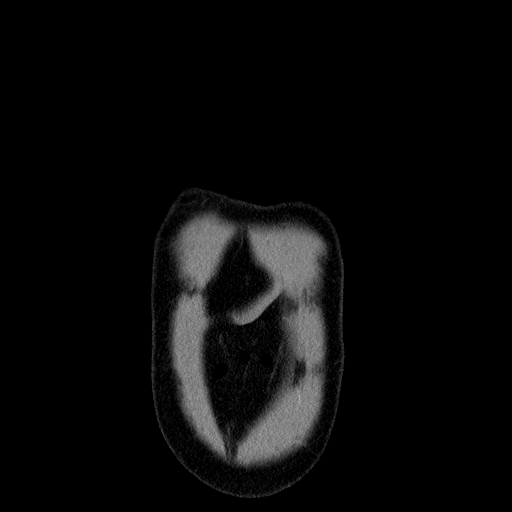 File:Codominant double aortic arch (Radiopaedia 56012-62637 B 2).jpg