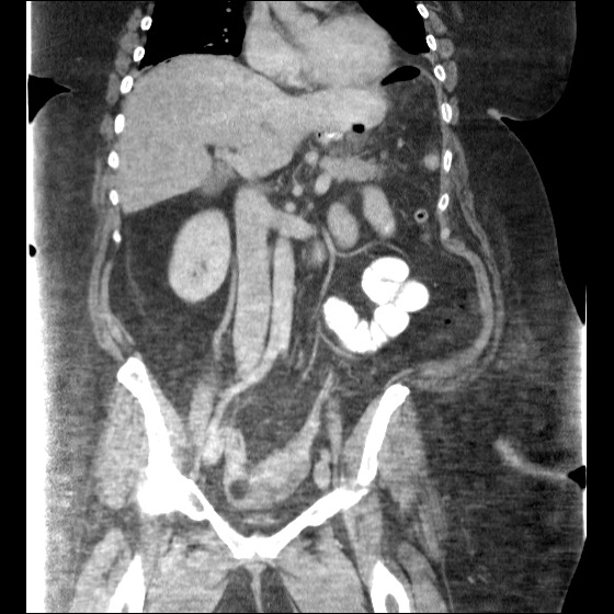 File:Collection due to leak after sleeve gastrectomy (Radiopaedia 55504-61972 B 26).jpg