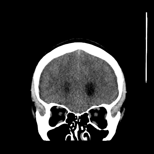 Colloid cyst (resulting in death) (Radiopaedia 33423-34469 Coronal non-contrast 13).png