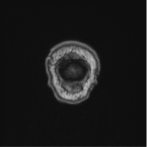 Colloid cyst of the third ventricle (Radiopaedia 86571-102662 Coronal T1 3).png
