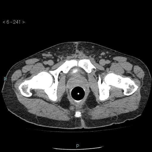 File:Colo-cutaneous fistula (Radiopaedia 40531-43129 A 101).jpg