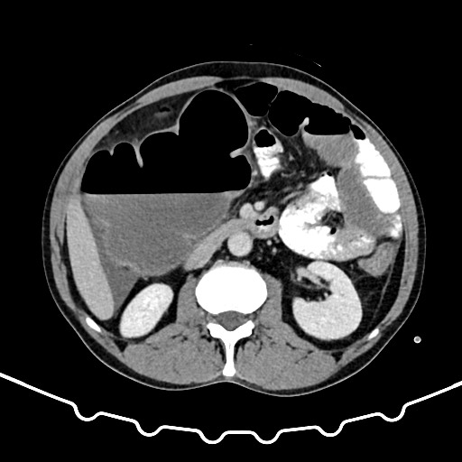 File:Colocolic intussusception due to large lipoma (Radiopaedia 68773-78482 A 78).jpg