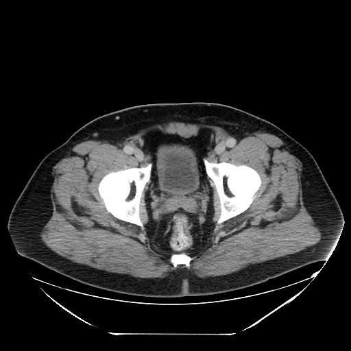 Colocolic intussusception due to lipoma (Radiopaedia 73712-84508 A 109).jpg