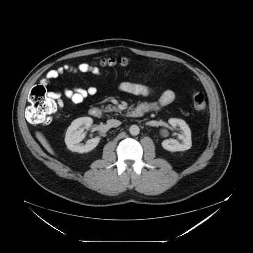 Colocolic intussusception due to lipoma (Radiopaedia 73712-84508 A 49).jpg