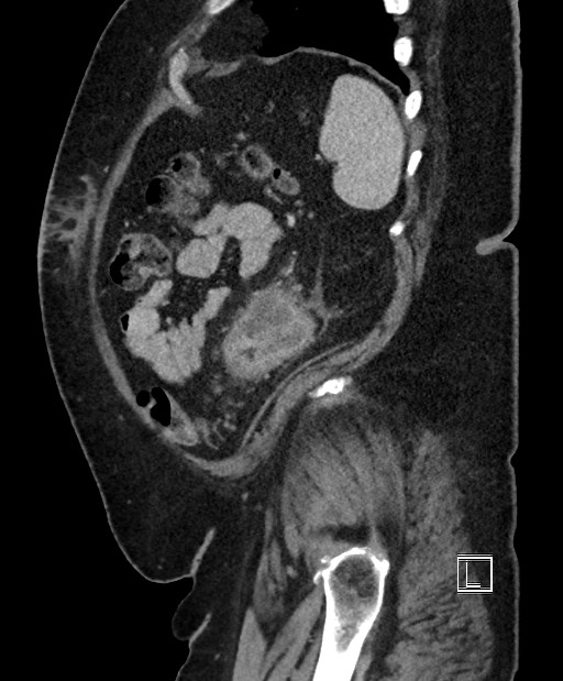 Colon adenocarcinoma (Radiopaedia 59374-66735 C 16).jpg