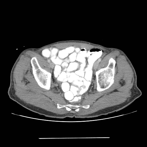 Colon cancer with calcified liver metastasis (Radiopaedia 74423-85307 A 67).jpg