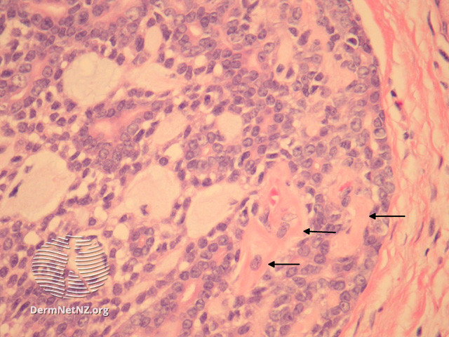 File:Figure 2 (DermNet NZ pathology-e-adenoid-cystic-figure-2).jpg