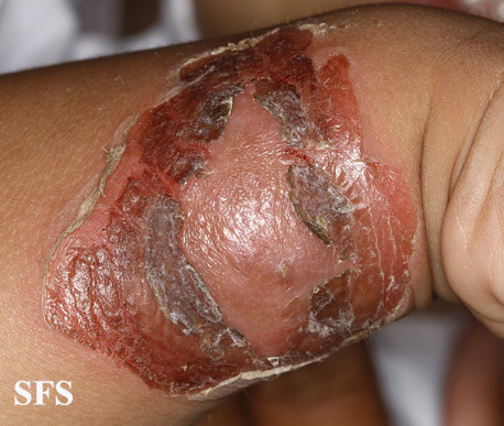 File:Impetigo (Dermatology Atlas 71).jpg