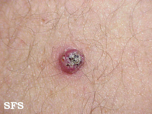 File:Keratoacanthoma (Dermatology Atlas 6).jpg