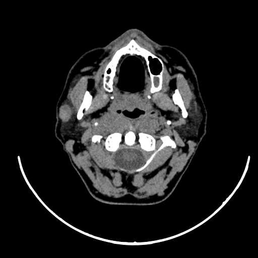 Nasopharyngeal carcinoma - infiltrating the clivus (Radiopaedia 62583-70875 Axial non-contrast 23).jpg