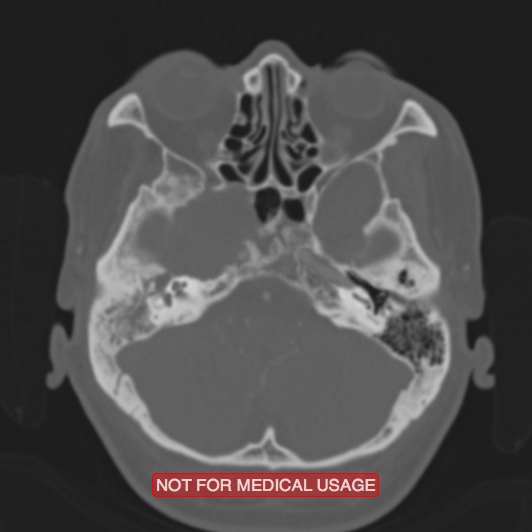 Nasopharyngeal carcinoma recurrence - skull base destruction (Radiopaedia 29107-29490 Axial bone window 83).jpg