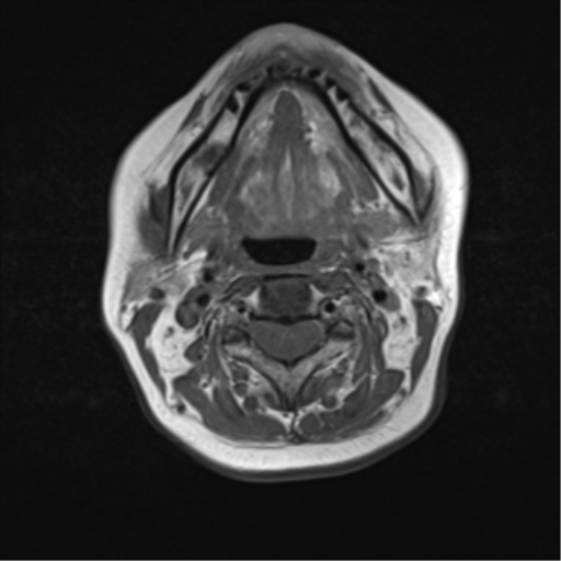 File:Nasopharyngeal carcinoma with cerebral abscess (Radiopaedia 43018-46273 Axial T1 29).png