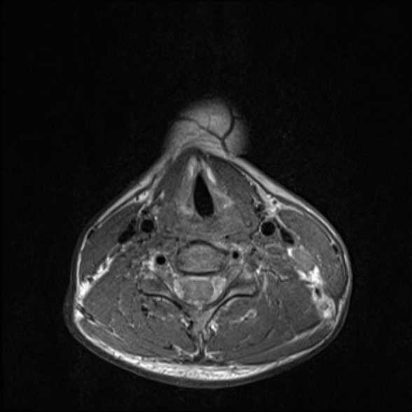 Nasopharyngeal carcinoma with skull base invasion (Radiopaedia 53415-59485 Axial T1 57).jpg