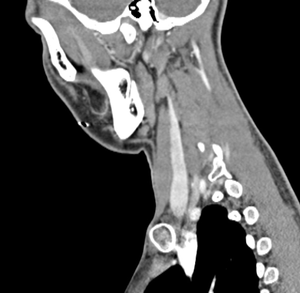 File:Nasopharyngeal carcinoma with skull base invasion (Radiopaedia 53415-59705 C 16).jpg
