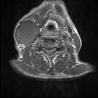 File:Nasopharyngeal carcinoma with skull base invasion (Radiopaedia 59258-66600 Axial T1 7).jpg