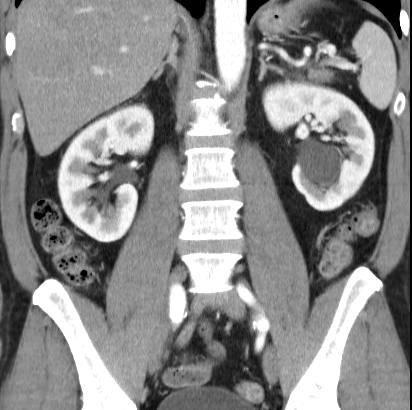 File:Necrotizing pancreatitis with acute necrotic collection (Radiopaedia 14470-14417 C 27).jpg
