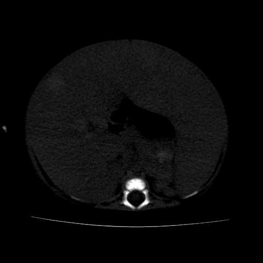 File:Neuroblastoma (Radiopaedia 20876-20799 Axial bone window 11).jpg